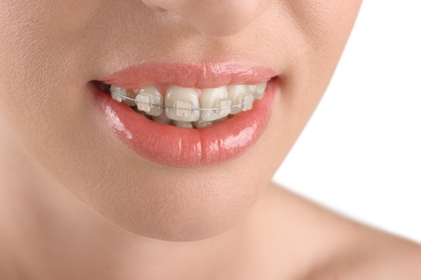 How To Keep Clear Braces From Staining