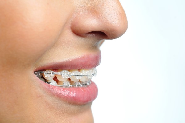 How To Take Care Of Your Teeth While You Have Clear Braces