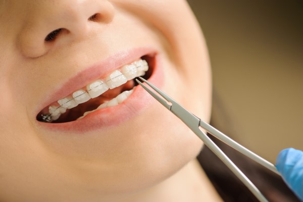 Tips To Keep Clear Braces From Staining