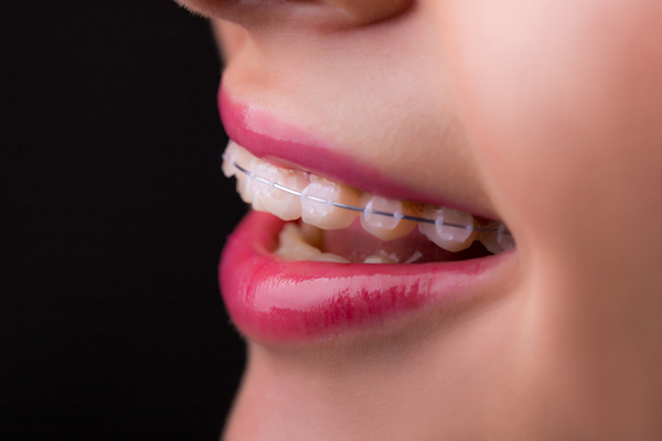 Why Clear Braces Are A Popular Option For Teeth Straightening