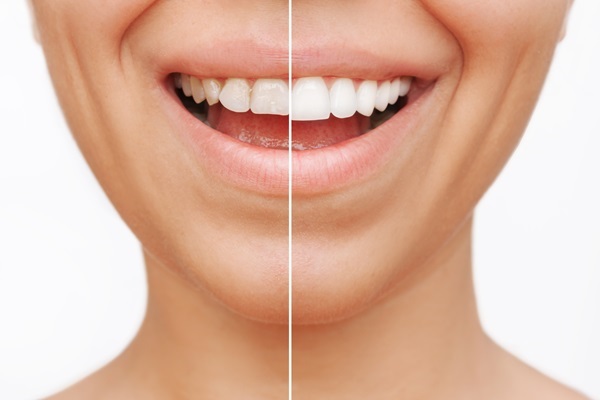 How Can A Cosmetic Dentist Boost Your Confidence?