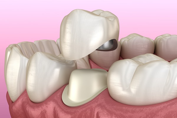Will I Need A Dental Crown  After A Root Canal?