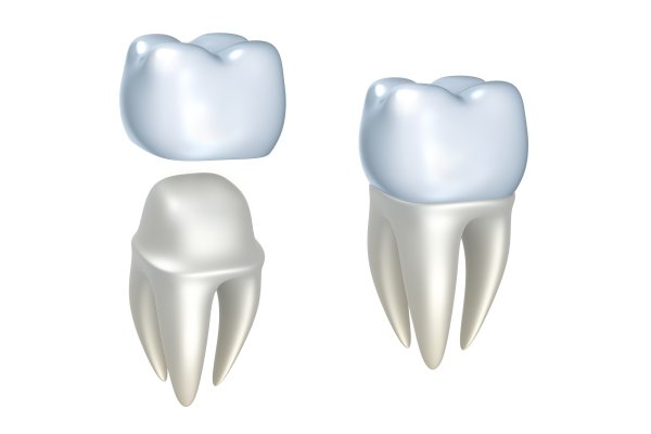 Can An Implant Crown Be Replaced?