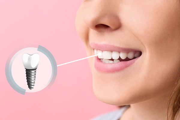 How To Care For Your New Dental Implant Restoration