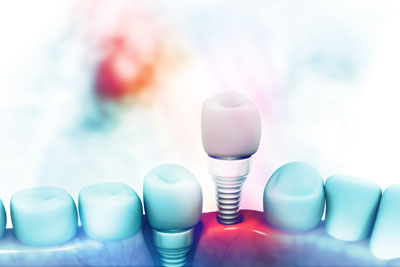 Visit Us Today To Receive Quality Dental Implants