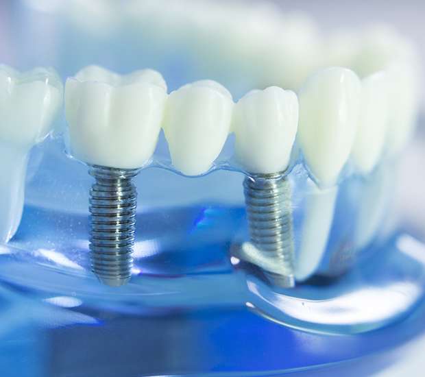 Huntsville Dental Prosthetics