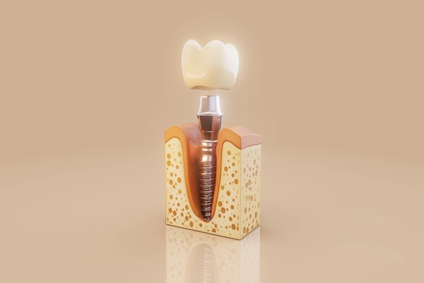 Aftercare Instructions From An Implant Dentist