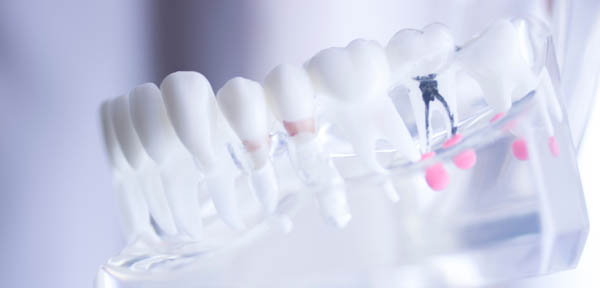 What Is The Purpose Of A Root Canal?