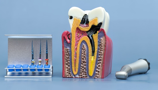 When Dental Pain May Indicate The Need For A Root Canal